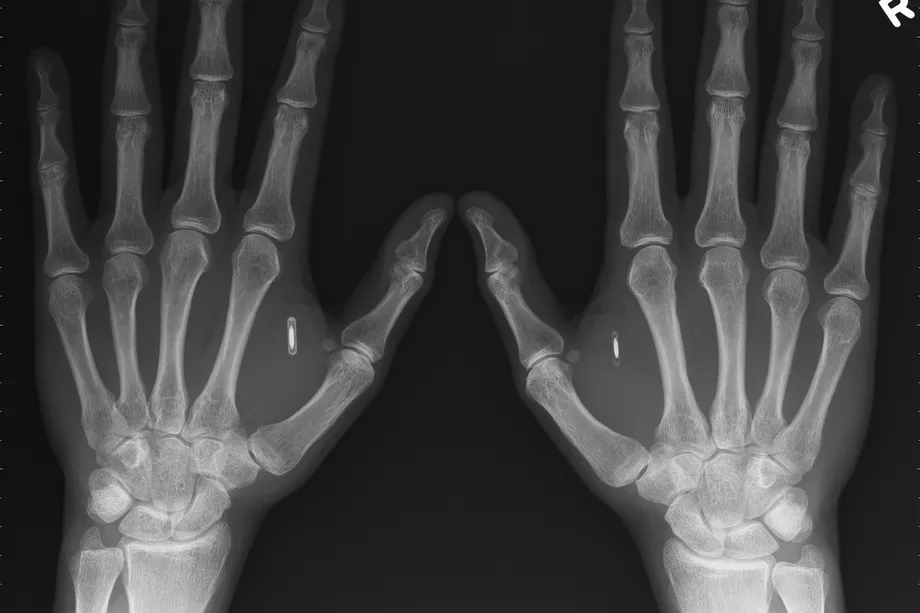 BIOHACKING : How I got two NFC implants @ DEF CON 27, why I bricked and how fixed it?